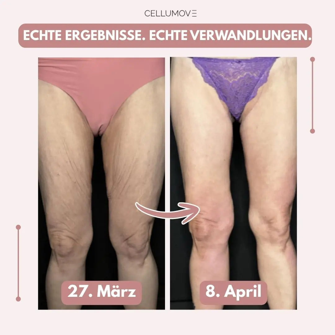 Firmer, smoother legs in 14 days — for women tired of being held back by sagging skin