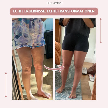 3D Legging - Say goodbye naturally to the pain and swelling of lipedema