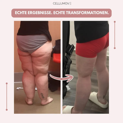 3D Legging - Say goodbye naturally to the pain and swelling of lipedema