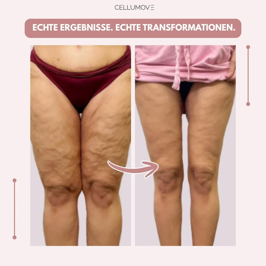 3D Legging - Say goodbye naturally to the pain and swelling of lipedema