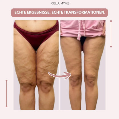 3D Legging - Say goodbye naturally to the pain and swelling of lipedema