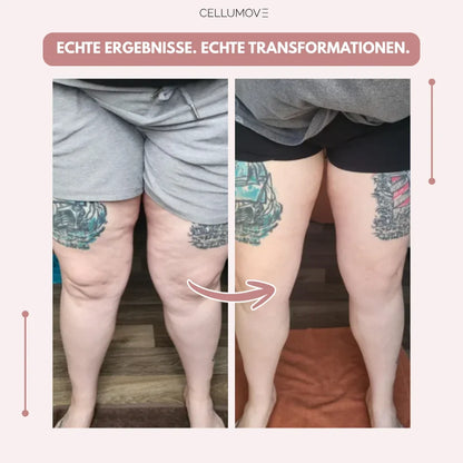 3D Legging - Say goodbye naturally to the pain and swelling of lipedema